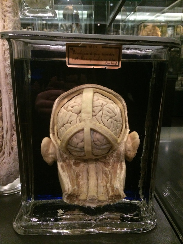 Human skull from behind with brain visible